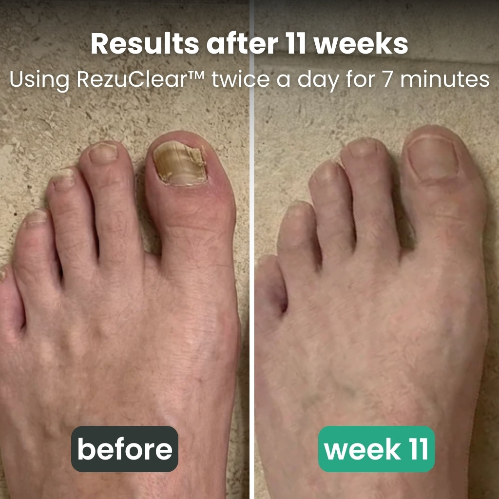 RezuClear™ - 3-in-1 therapy device